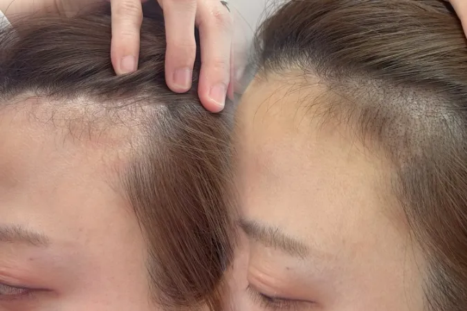 頭皮アートメイク