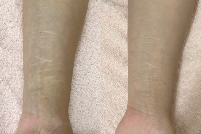 傷痕 / リストカット痕カモフラージュ