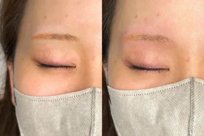 アートメイク薬剤除去・リップピールケア（くすみ除去）